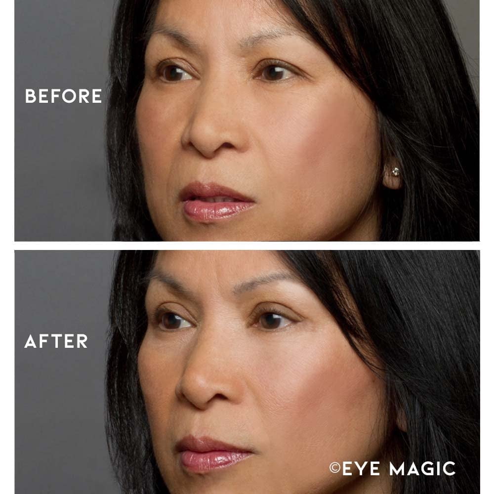 Eye Magic before and after - hooded eyelids lifted, natural result