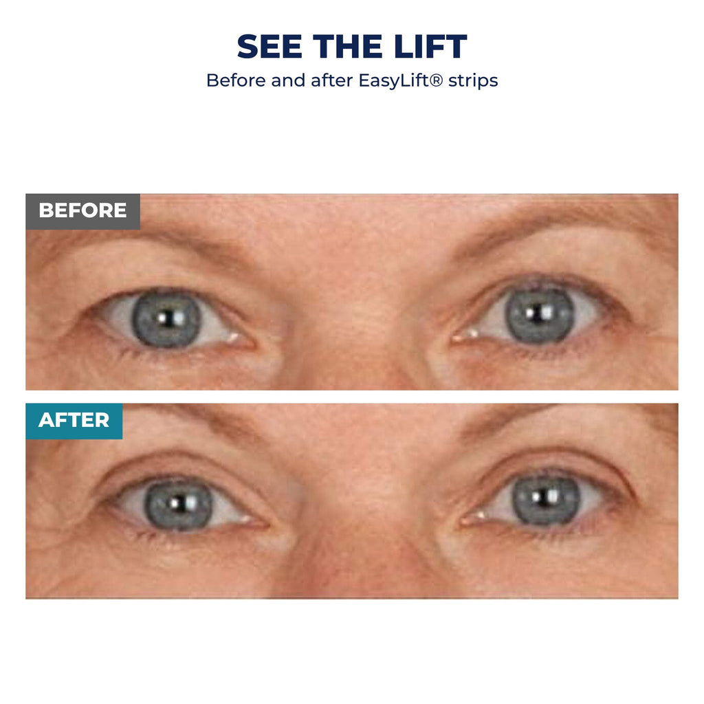 EasyLift before and after - real results, eyelid lifted