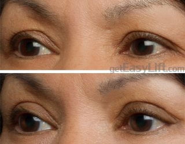 EasyLift Eye Lift application
