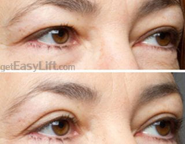 EasyLift Eye Lift results