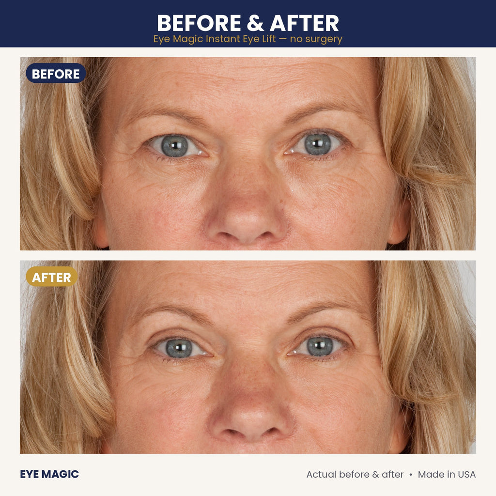 Eye Magic before and after - droopy upper eyelids lifted, close-up