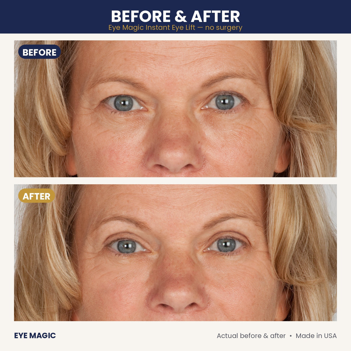 Eye Magic before and after - droopy upper eyelids lifted, close-up