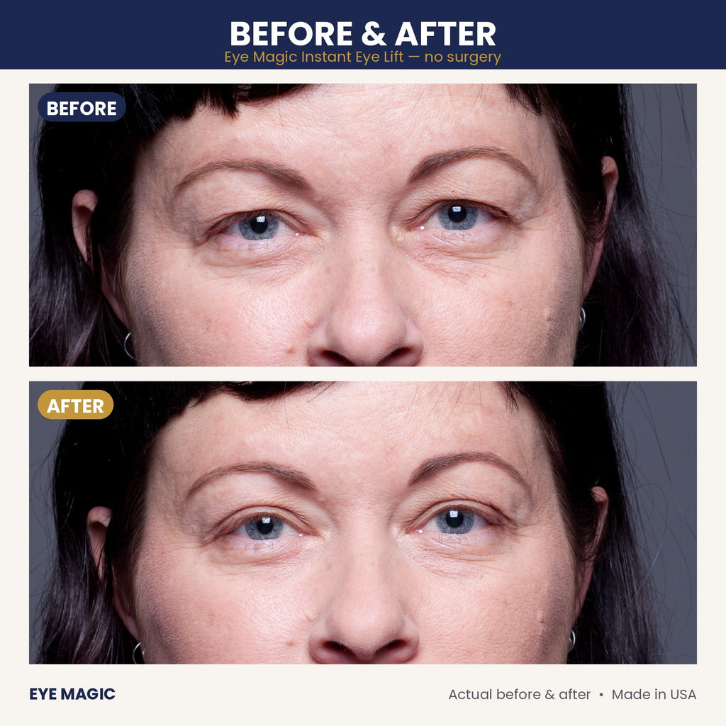 Eye Magic before and after - hooded eyelids lifted, close-up