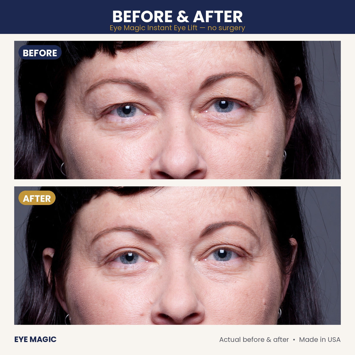 Eye Magic before and after - hooded eyelids lifted, close-up